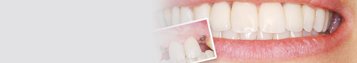 Implants are often the best option for replacing missing teeth.